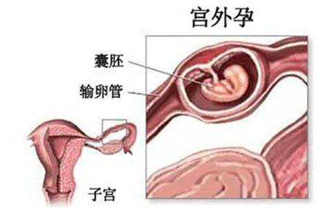 想找广州代孕，广州hpv疫苗
