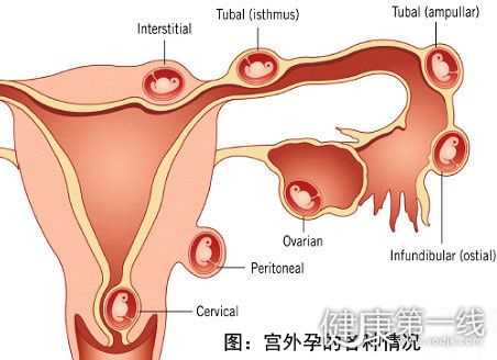广州借卵生子是什么意思-广州有做代生的医院吗-妊娠纹怎么淡化去除 这4个方