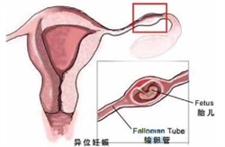 广州供卵代怀，怀孕4个月肚子有多大？