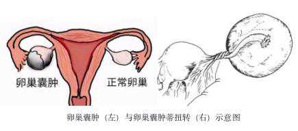 13岁少女突发腹痛竟是妇科急症，广州医生单孔腹腔镜剥囊肿